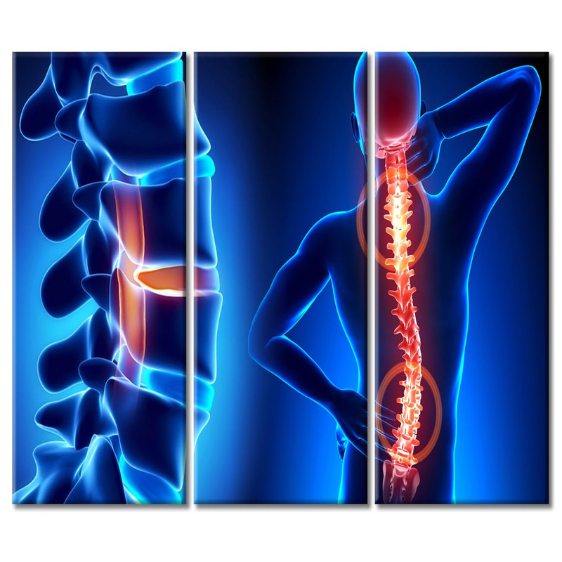 Tumovo Human Backache And Back Pai Modern Artwork Wall Decor 3 Panel Spine And